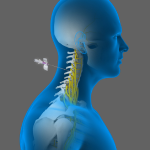 Cervical Epidurals