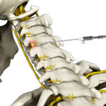 Cervical Facet Radiofrequency Neurotomy