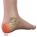 Heel Pain