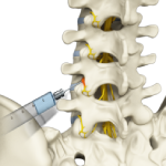 In-Office Lumbar Injections