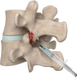 Lumbar Facet Block