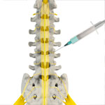 Lumbar Medial Branch Block