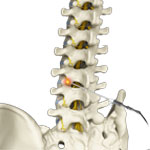 Lumbar Spondylosis Radiofrequency Ablation