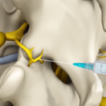 Medial Branch Block Injections