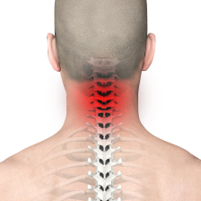 Neck Pain