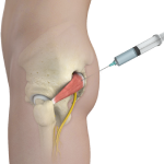 Piriformis Muscle Injection