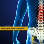 Spinal Cord Stimulator