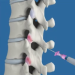 Thoracic Facet Joint Injection